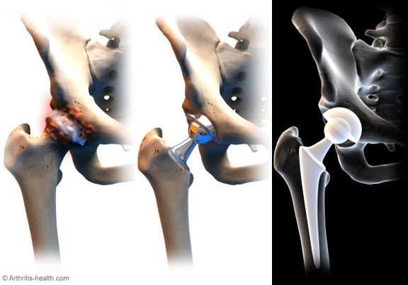 post lumbar puncture instructions