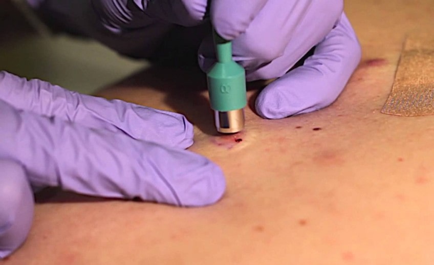skin biopsy care instructions